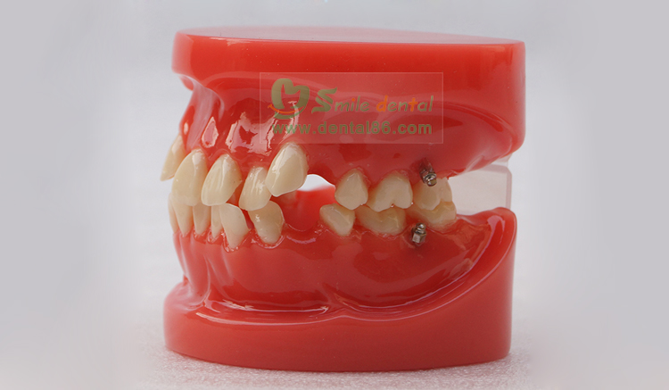 TM-B1 Orthodontic Model